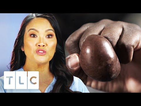 Dr. Sandra Lee Inspects Ginormous Mass On Man's Finger | Dr. Pimple Popper